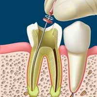 Clinica dental coproaro tratamiento de endodoncia